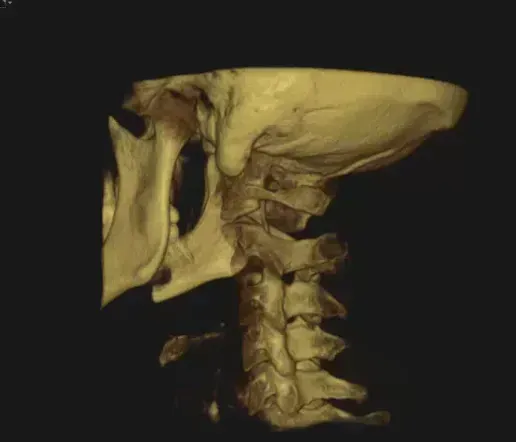 3D CBCT scan of the skull base and upper cervical spine, used to plan precise, gentle migraine care