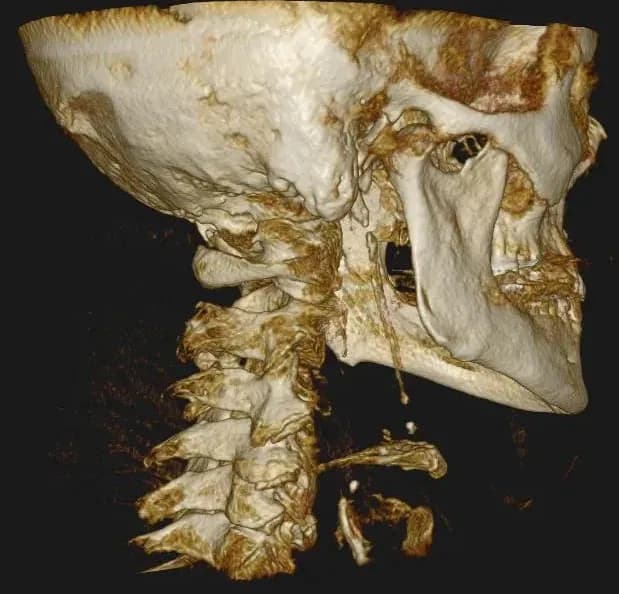 CBCT 3D imaging of the skull and neck used to plan a precise correction for vertigo care in Oceanside