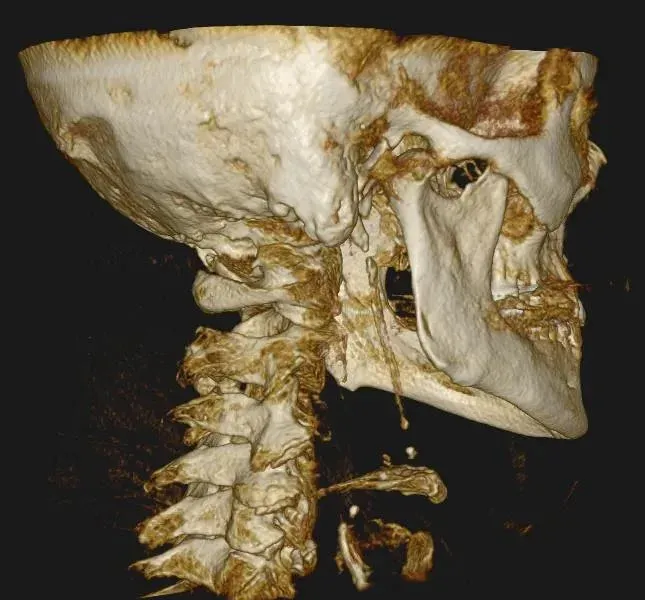 3D CBCT scan showing the base of the skull and upper neck, where many recurring headaches originate