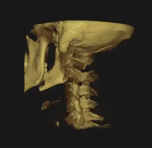 3D CBCT scan of the skull and cervical spine used to plan precise neck pain care in Oceanside