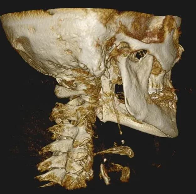 3D CBCT scan of the upper cervical spine used to check for misalignment during tinnitus care