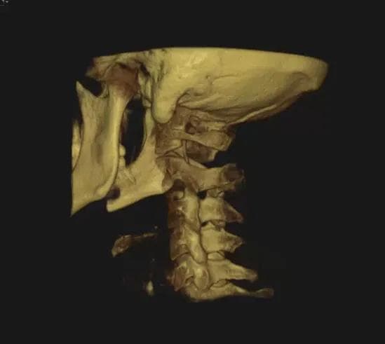 CBCT 3D imaging used to plan a precise Blair upper cervical correction in Oceanside