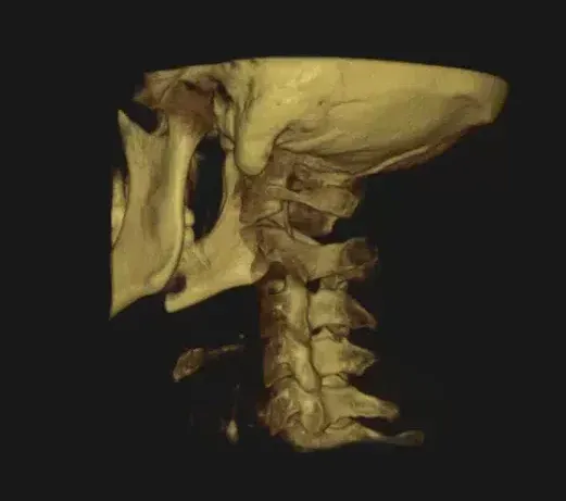CBCT 3D render of the neck and jaw reviewed during a tinnitus evaluation in Oceanside