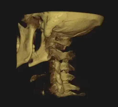 3D CBCT scan of the upper cervical joints that help the brain sense head position and balance