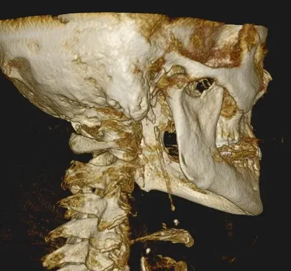 3D CBCT scan of the neck joints, showing the bony detail used to assess arthritis in the spine