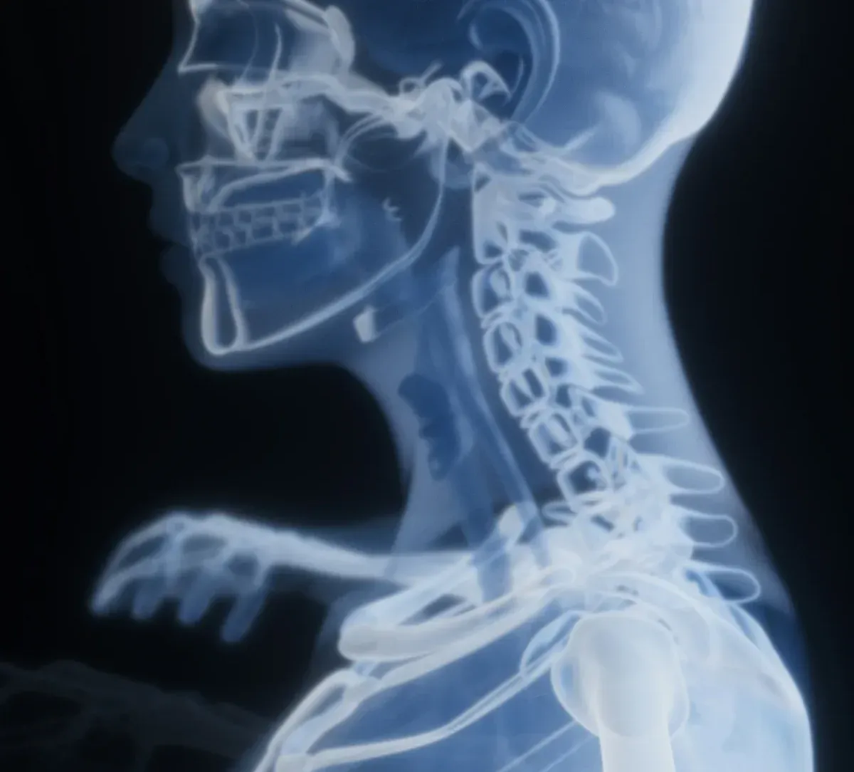 X-ray style illustration of the cervical spine, where neck pain and stiffness often begin